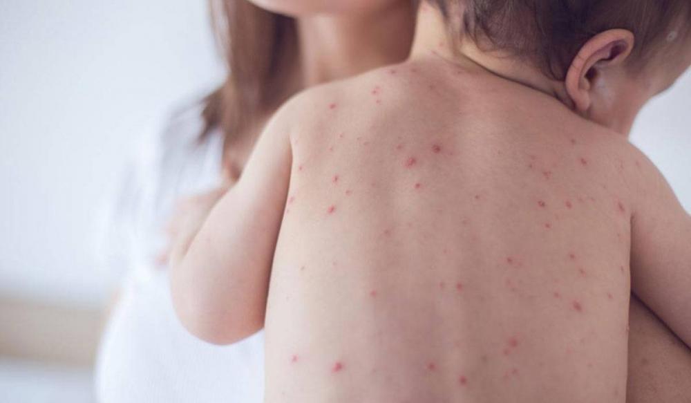 الصحة العالمية تحذّر من ارتفاع عدد مرضى الحصبة