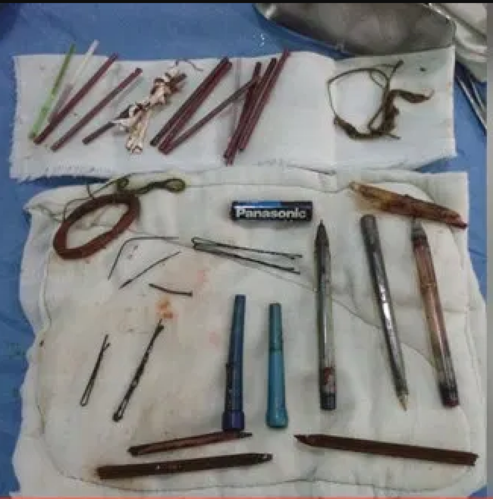 عملية جراحية لشاب في مشفى تشرين لإزالة أدوات صلبة  